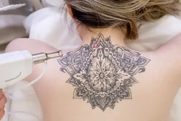 detatouage-femme-paris Femme se faisant détatouer à Paris